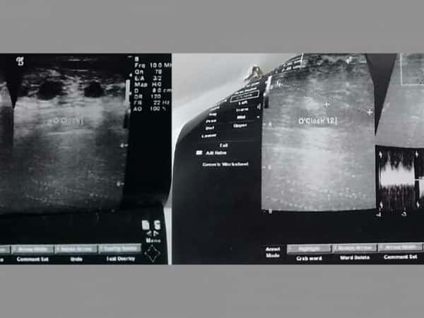 elderly woman needs chemotherapy