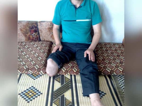 An Injured Man Needs a Prostheses