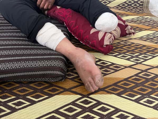 طرفٌ صناعي يعيدُ له الأمل