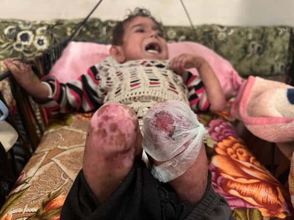 Fatima suffers from pemphigus.