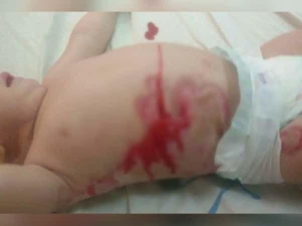 a child with sever burns