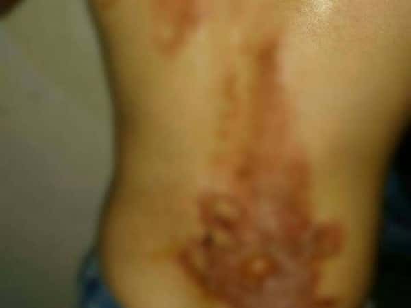 A refugee child in Lebanon needs burns treatment