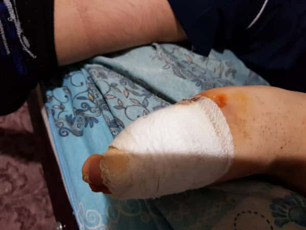 A kid suffers from foot inflammations