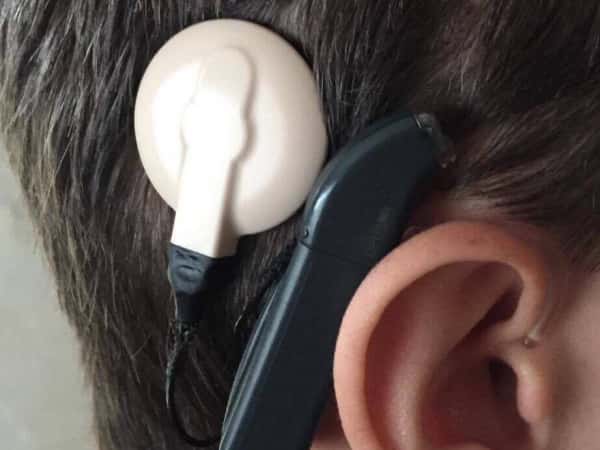 Child needing an artificial ear transplant