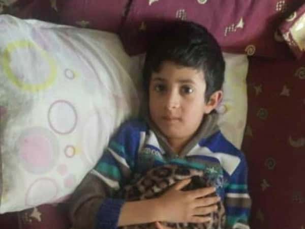 A Child Needs Lupusectomy and Nasalisectomy