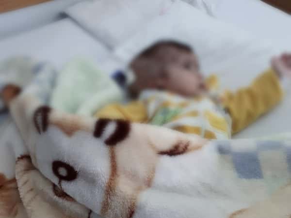 baby with hydrocephalus