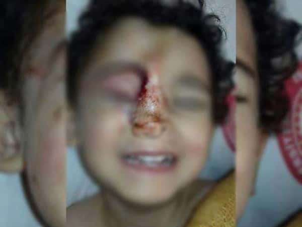 Kid with 4 fragments in the face and lost his eye