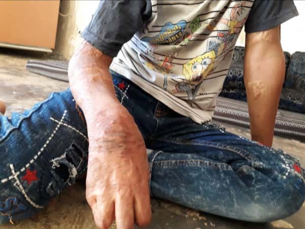 a child with burns