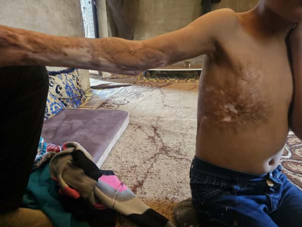 الحروق تأكل جسد الصغيرة وصال