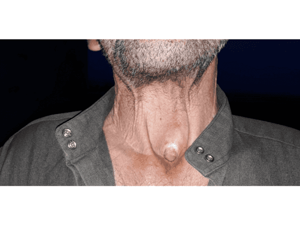 رجل ترك له السرطان فتحة في حلقه!
