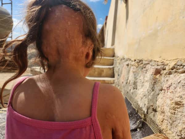 A child with burns needs medications and treatments