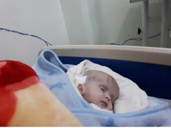 baby with hydrocephalus