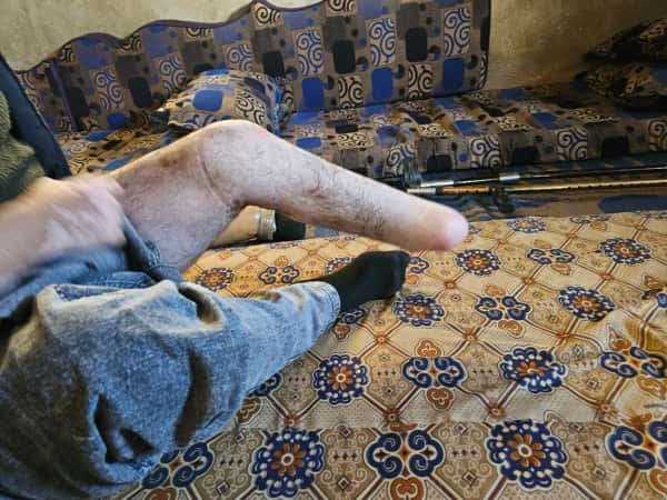 A Landmine That Took His Leg