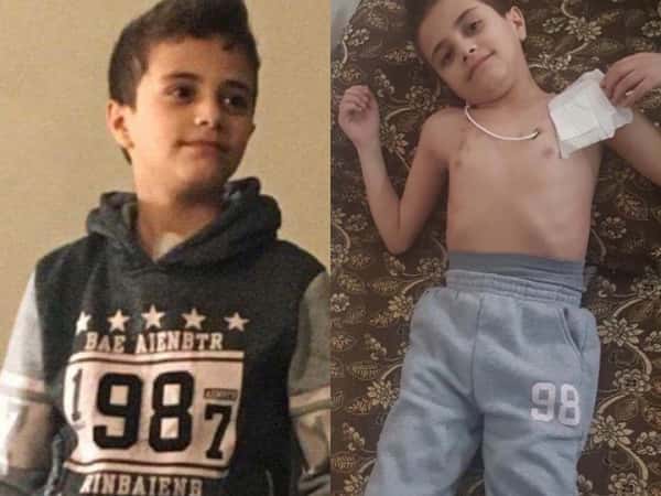 a kid with liver cirrhosis