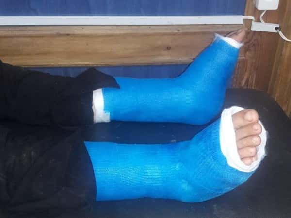 A young girl needs internal fixation