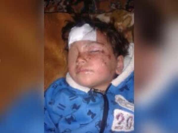 A Little Girl in Need of Urgent Eye and Head Operations