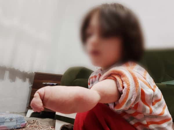 طفلة خُلقت بيد مشوهة وغير مكتملة النمو