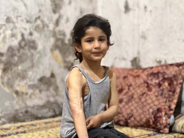 معاناة أسيل مع فقدان السمع وآثار الحروق