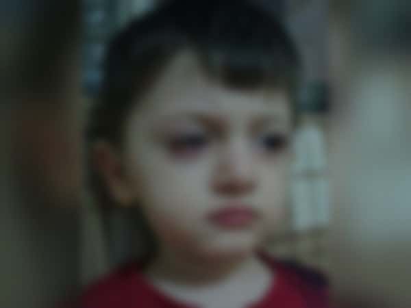Child in need of eye surgery
