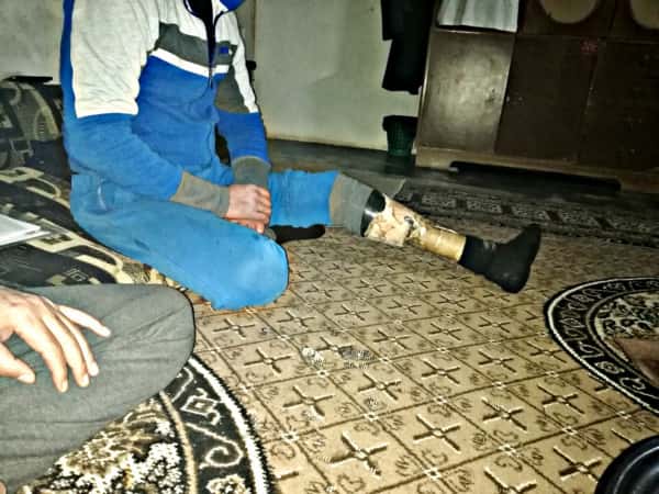 شاب يعيش بقدمٍ مبتورة!