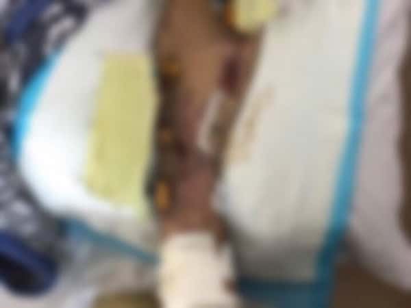 Young man suffering from crushing and breaking his foot