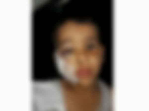 A child has a fracture near to eye
