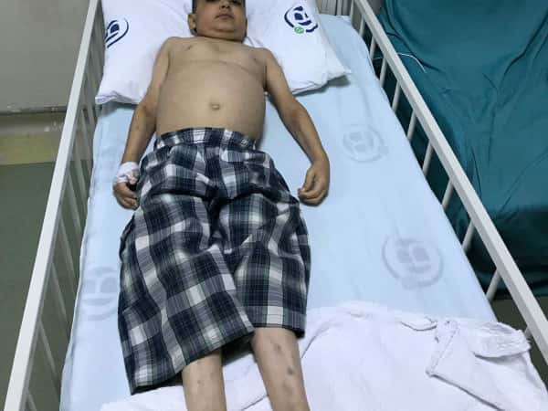 kid with very weak immune system, breathing difficulties and kidneys shutdown