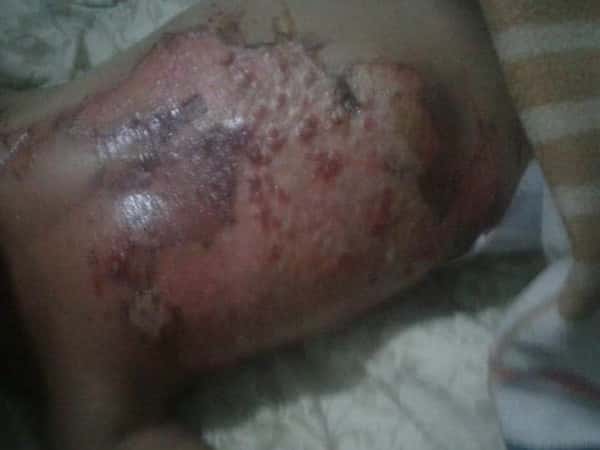 A Little Girl Has to Have an Urgent Care for a Burn