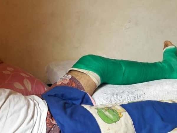 A young boy needs external fixation of his feet