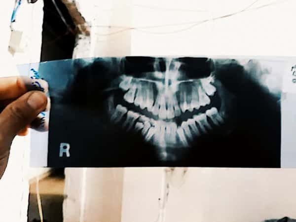 child with protuberance of teeth