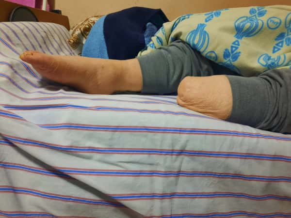 At the age of seventy, he faces life with an amputated leg and a chronic disease!