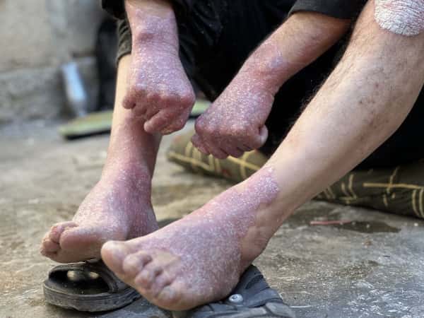 جلده يتشقق من الألم!