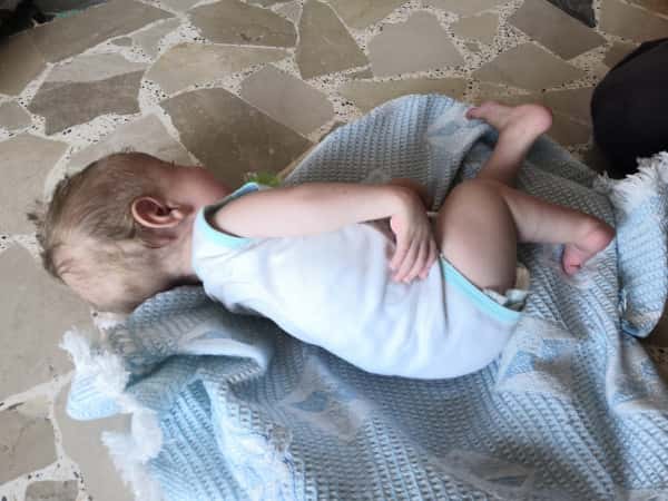 A child with out-toeing feet