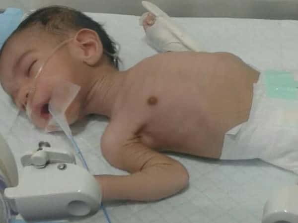 A Baby in Need of a Stomach Surgery
