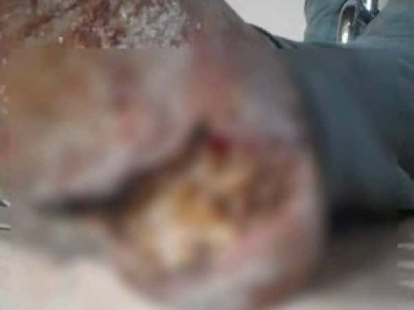 Patient needs Urgent surgery