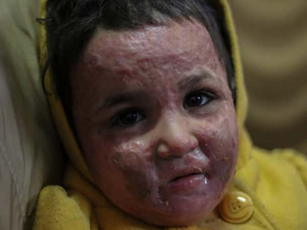 A girl child with sever burns