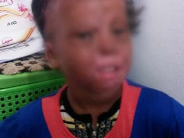 female kid infected with serious burns