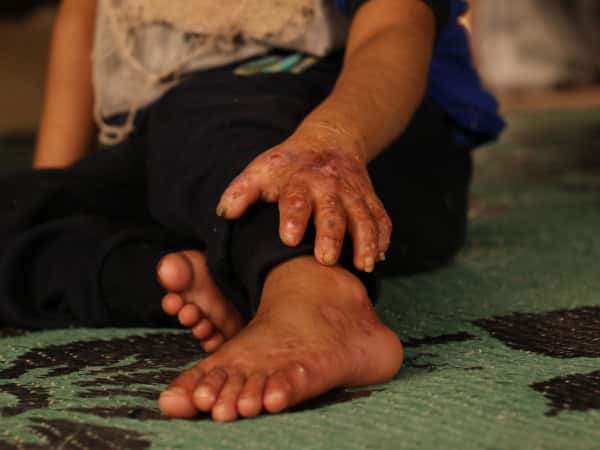 A 7-years-old suffering from Pemphigus