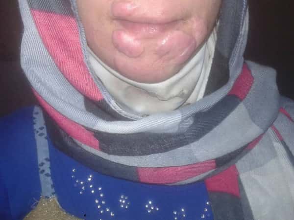 Laser sessions for burns