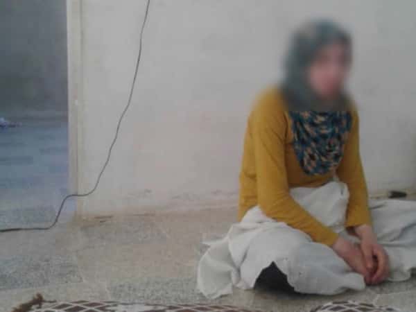 شابة حُرق كامل جسدها مسبباً لها تشوهات