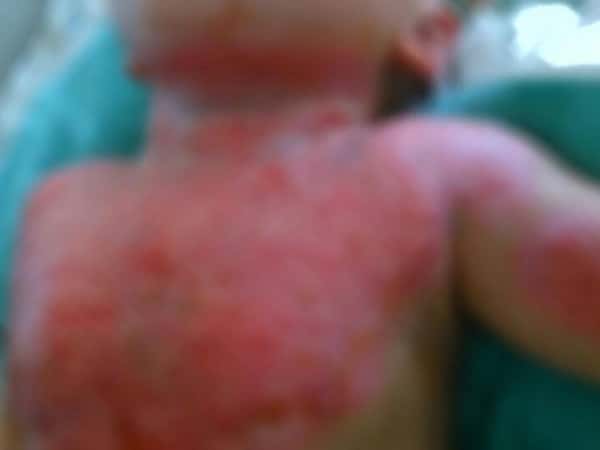 Sundus, small baby subjected to burns
