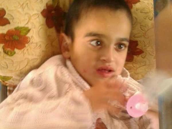 A child suffers from cerebral  atrophy