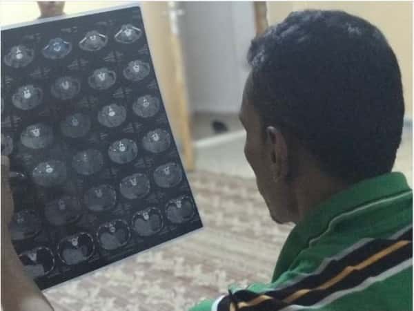 A man with kidney stones