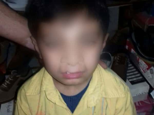 A child with congenital malformation