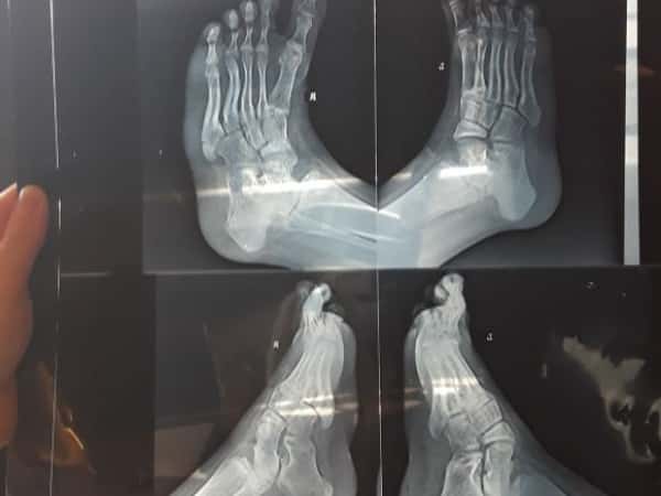 Club foot surgical correction