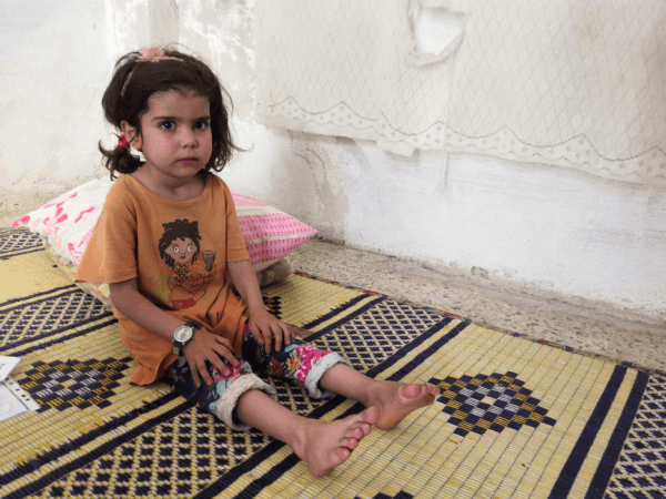 A girl child suffers from pulmonary fibrosis