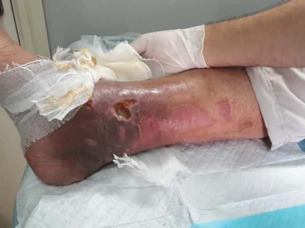 Elderly needs urgent surgery to avoid amputation