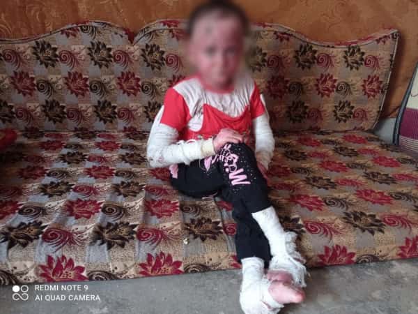 A girl suffering from a chronic congenital skin disease