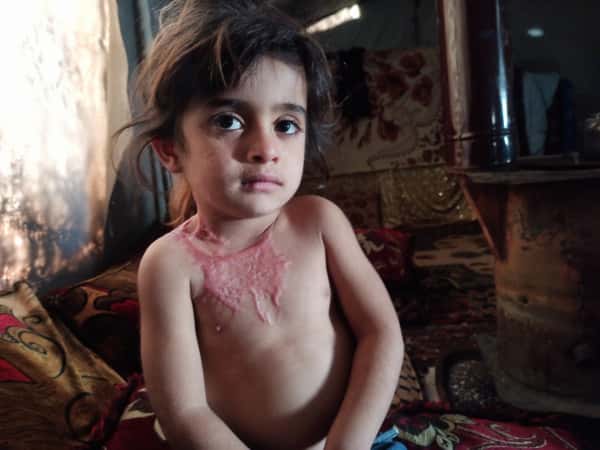 The little girl Nora is suffering from a neck burn.