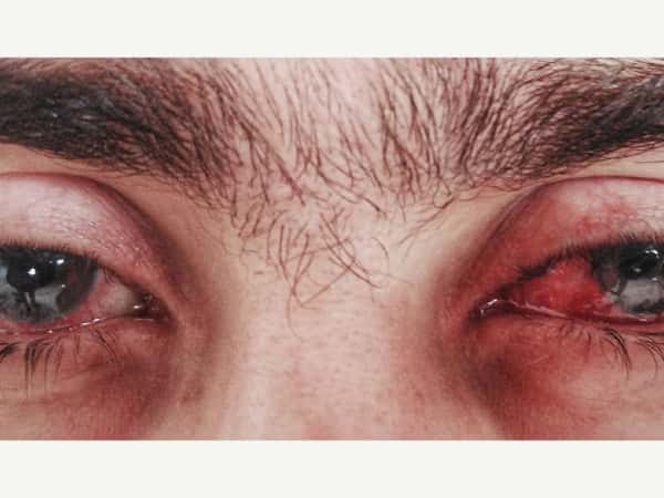 A young man needs eye surgery